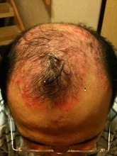 scalp psor before